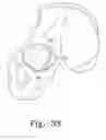 Fig. 22 - Reciprocating rasps for use in an orthopaedic surgical procedure