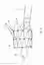 Fig. 22 - Prosthetic valve for transluminal delivery