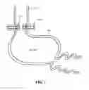 Fig. 02 - Ring Magnet for Obesity Management