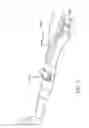 Fig. 06 - Preparation For Endovenous Laser Ablation