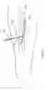 Fig. 09 - Preparation For Endovenous Laser Ablation