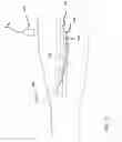 Fig. 10 - Preparation For Endovenous Laser Ablation