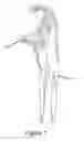 Fig. 02 - CORONOID FRACTURE FIXATION DEVICE