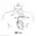Fig. 09 - Methods and systems for recognizing arrhythmias using neural stimulation