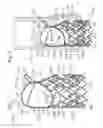 Fig. 02 - Low-profile heart valve and delivery system