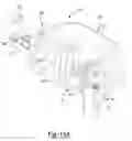 Fig. 17 - Modular lateral hip augments