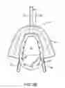 Fig. 06 - Methods and systems for improving airway patency