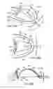 Fig. 33 - Methods and systems for improving airway patency