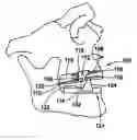 Fig. 01 - MANDIBULAR ADVANCEMENT SPLINT