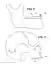 Fig. 03 - MANDIBULAR ADVANCEMENT SPLINT