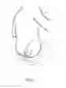 Fig. 02 - Removable Patch for Covering a Portion of a Body from View