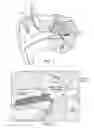 Fig. 02 - Inner Ear Drug Delivery Device and Method