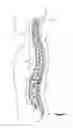 Fig. 02 - Odontoid fracture dynamic compression apparatus and method