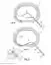 Fig. 07 - Device and method for treatment or evacuation of intervertebral disc or vertebral body