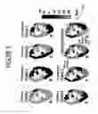 Fig. 04 - Electrophysiologic Testing Simulation For Medical Condition Determination