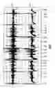 Fig. 02 - INTRACARDIAC ELECTROGRAM TIME FREQUENCY NOISE DETECTION