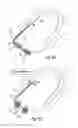 Fig. 06 - Devices, systems and methods for the treatment of sleep apnea