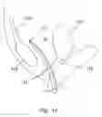 Fig. 12 - Method for soft tissue anchoring with introducer