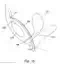 Fig. 13 - Method for soft tissue anchoring with introducer