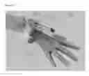 Fig. 05 - Bone distraction system