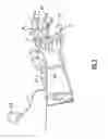 Fig. 03 - Birthing glove