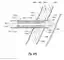 Fig. 72 - Clip applier and methods of use