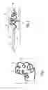 Fig. 02 - Thrombus removal system and process