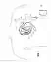 Fig. 02 - Implantable myocardial ischemia detection, indication and action technology