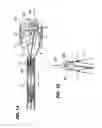 Fig. 02 - Stent