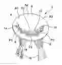 Fig. 01 - DYNAMICALLY ADJUSTABLE SUTURE AND CHORDAE TENDINAE