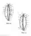 Fig. 07 - BIOCOMPATIBLE BIODEGRADABLE INTRAOCULAR IMPLANT SYSTEM
