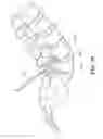 Fig. 09 - Percutaneous arthrodesis method and system