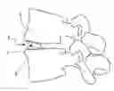 Fig. 01 - Intersomatic cage