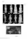 Fig. 02 - METHODS OF SCREENING FOR COMPOUNDS FOR USE AS MODULATORS OF LEFT-RIGHT ASYMMETRY IN SCOLIOTIC SUBJECTS AND FOR MONITORING EFFICACY OF AN ORTHOPAEDIC DEVICE