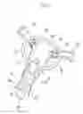 Fig. 02 - Spreader for aortic valve reconstruction
