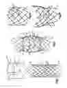 Fig. 02 - Method for direct implantation of a heart valve prosthesis