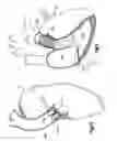 Fig. 06 - Method for direct implantation of a heart valve prosthesis