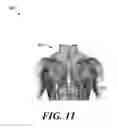Fig. 12 - Device for stimulating adaptive thermogenesis in brown adipose tissue
