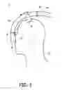 Fig. 02 - RESPIRATORY INTERFACE DEVICE INCLUDING A MECHANISM FOR MANAGING NOSE BRIDGE PRESSURE
