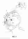 Fig. 03 - RESPIRATORY INTERFACE DEVICE INCLUDING A MECHANISM FOR MANAGING NOSE BRIDGE PRESSURE