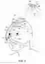 Fig. 04 - RESPIRATORY INTERFACE DEVICE INCLUDING A MECHANISM FOR MANAGING NOSE BRIDGE PRESSURE