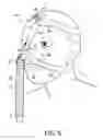 Fig. 07 - RESPIRATORY INTERFACE DEVICE INCLUDING A MECHANISM FOR MANAGING NOSE BRIDGE PRESSURE