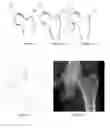 Fig. 02 - Morphometry of the human hip joint and prediction of osteoarthritis