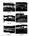 Fig. 02 - Soft tissue and bone augmentation and bulking utilizing muscle-derived progenitor cells, compositions and treatments thereof