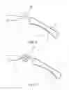 Fig. 05 - SEGMENTAL DISTALIZATION ELEMENT FOR ORTHODONTIC TREATMENTS