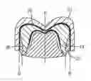 Fig. 01 - Method of making a dental restoration from a frame and a veneer