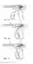 Fig. 11 - Methods of deploying an implantable injection port