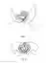 Fig. 06 - Pelvic implant with anchoring frame
