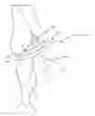 Fig. 01 - CLOSED LOOP GASTRIC RESTRICTION DEVICES AND METHODS