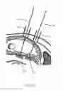 Fig. 23 - CLOSED LOOP GASTRIC RESTRICTION DEVICES AND METHODS